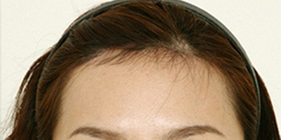 額頭縮小術后