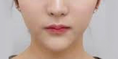 SMAS除皺術(shù)術(shù)后