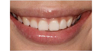 注射去露齦笑術前