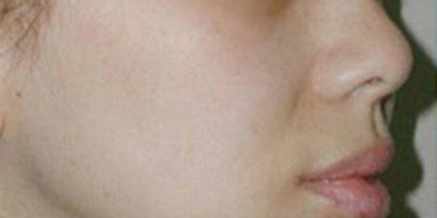 注射去法令紋術前