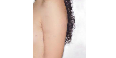 射頻溶脂瘦手臂術(shù)前