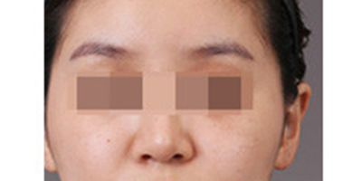 自體脂肪豐眉弓術前