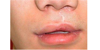 唇部修復(fù)術(shù)前