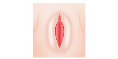 小陰唇手術(shù)術(shù)后