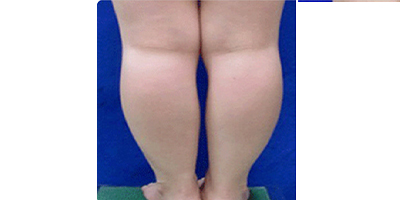 共振吸脂術術前