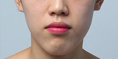 假體豐下巴術(shù)前