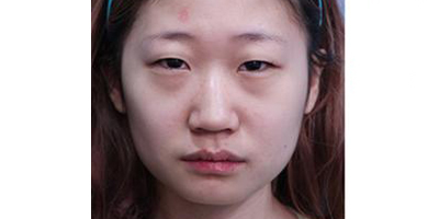 耳軟骨隆鼻術(shù)前