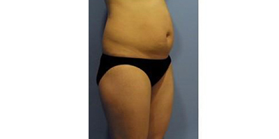 腹部吸脂術(shù)前