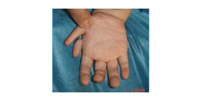 多指矯正術(shù)前