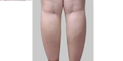動氧瘦小腿術(shù)前