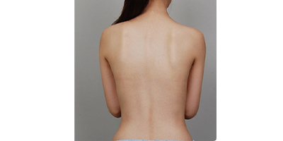 吸脂瘦背部術(shù)后