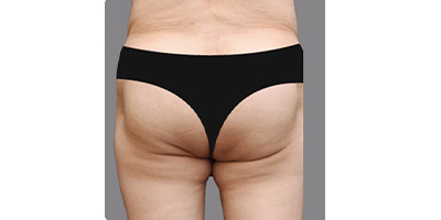 射頻溶脂瘦臀部術(shù)前