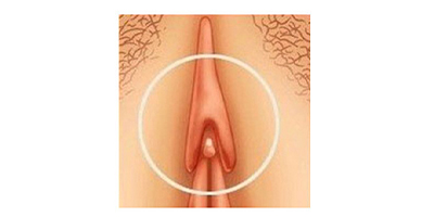 陰蒂整形術(shù)術(shù)前