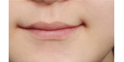玻尿酸豐唇珠術(shù)前