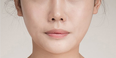 假體豐下巴術(shù)后