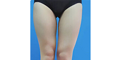 大腿吸脂術(shù)前