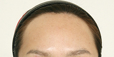額頭縮小術前