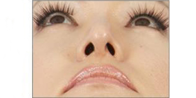 手術(shù)縮鼻頭術(shù)后