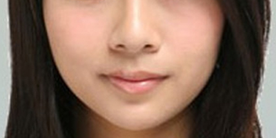 自體脂肪豐面頰術(shù)后