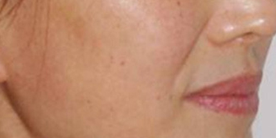 手術去法令紋術前