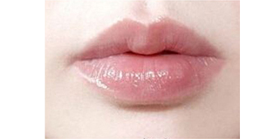 自體脂肪豐唇術(shù)后