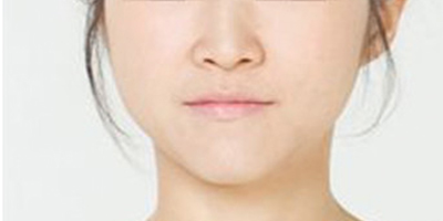 光纖溶脂瘦臉術后