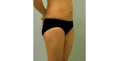 腹部吸脂術(shù)后