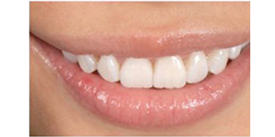 注射去露齦笑術后