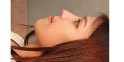 埋線隆鼻術(shù)后