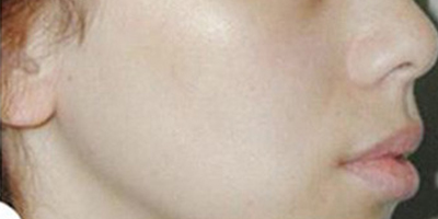 注射去法令紋術后