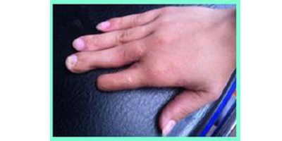 手指巨指矯正術后