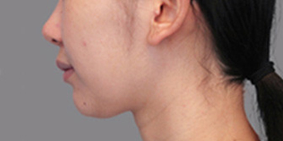 硅膠墊下巴術(shù)前