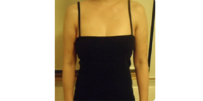 射頻溶脂瘦肩膀術(shù)后