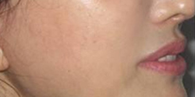 手術去法令紋術后