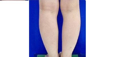 共振吸脂術術后