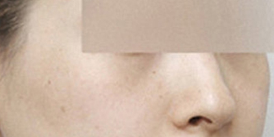 顴弓降低術(shù)后