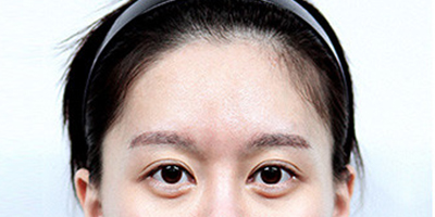 假體豐太陽穴術(shù)前