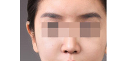 自體脂肪豐眉弓術后