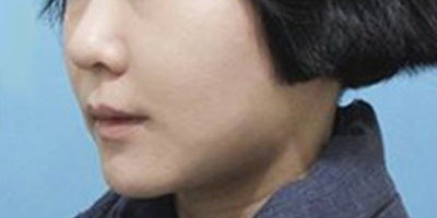 埋線提升術(shù)后