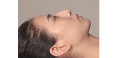 長鼻矯正術(shù)前