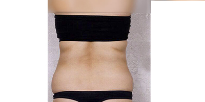 優(yōu)立塑術(shù)前