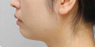 膨體墊下巴術(shù)前