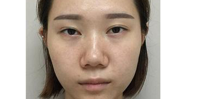 鼻中隔軟骨隆鼻術前