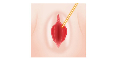 小陰唇手術(shù)術(shù)前