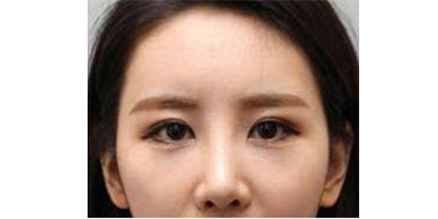 膠原蛋白豐淚溝術后