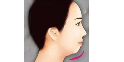 假體豐下巴術前