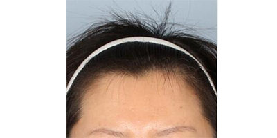 脫發(fā)際線術(shù)前