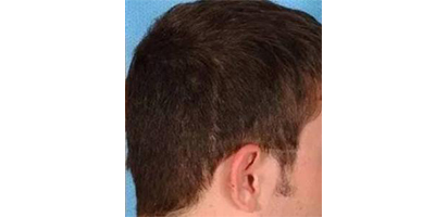 疤痕種植術(shù)后