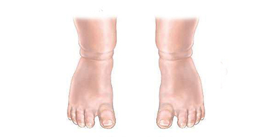 足內(nèi)翻矯正術后