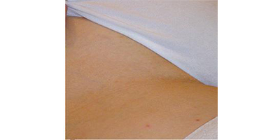 私密脫毛術(shù)后